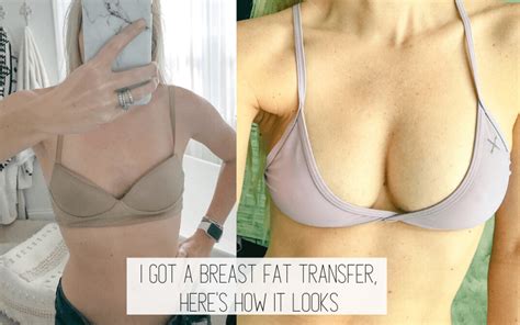 Before And After Breast Fat Transfer Ancestral Nutrition
