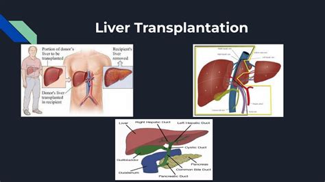Ppt Liver Transplantation Surgery In India Powerpoint Presentation
