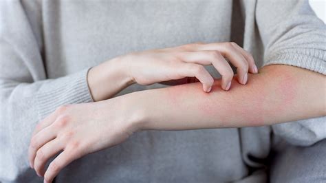 Some Moderna Covid 19 Vaccine Recipients Have Experienced Delayed Skin
