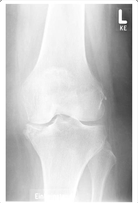 case 1 patient anterior posterior radiography left knee medial tibial download scientific