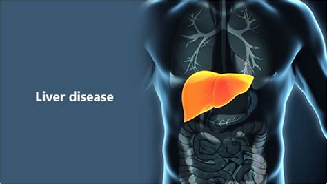 Liver Disease And Treatments That Actually Work Centi Metro News