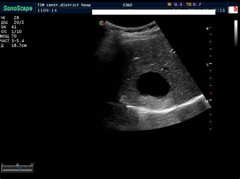 Киста в печени диета лечение Киста Печени Причины И Лечение Диета — Похудение Диета Правильное Питание Киста Печени Причины И Лечение Диета — Похудение Диета Правильное Питание Киста в печени диета лечение