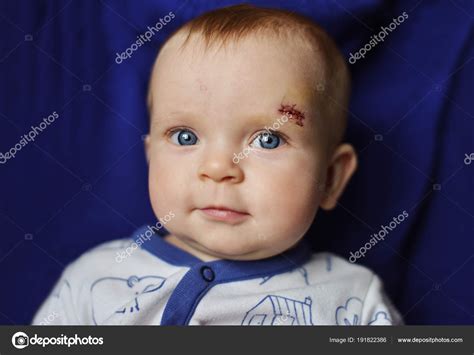 Blue Eyed Baby Scar Face Stock Photo By ©reanas 191822386