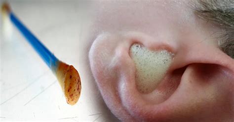 This is enough to break the ear waxes. How to Properly Clean, Unblock and Remove Your Ear Wax ...