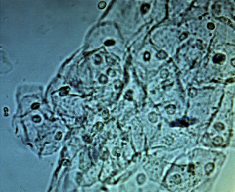 Their presence indicates acute or chronic affection of the kidneys. Medicine 1 > Calabrese > Flashcards > kidney 1 A | StudyBlue