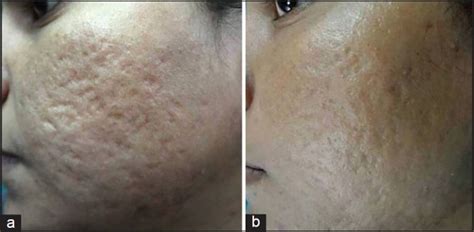 A Grade 4 Acne Scars B Improvement In Acne Scars From Grade 4 To