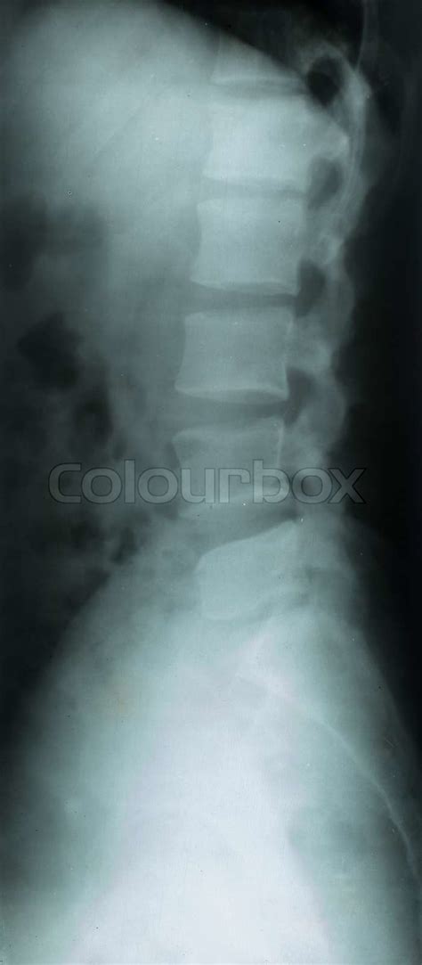 X Rays Of Human Neck Bone Stock Image Colourbox