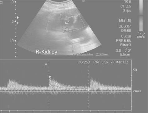 Sonographic Comparison Of Segmental Artery Resistive Index With