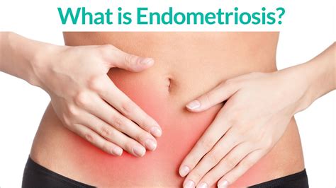Results of a prospective, multicenter dienogest is as effective as intranasal buserelin acetate for the relief of pain symptoms associated. What is "Endometriosis" and what are the "Endometriosis ...