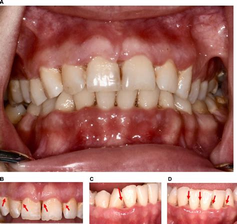 Frontiers Necrotizing Periodontal Disease In A Nutritionally