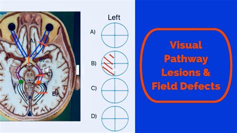 Visual Pathway Lesions And Field Defects Youtube