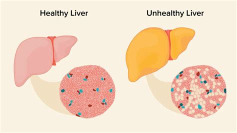 What Is Fatty Liver Disease Symptoms Causes And Treatments Articleroof
