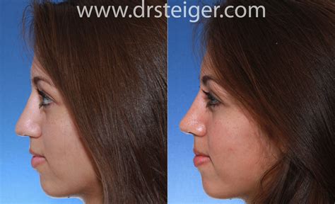 Rhinoplasty Before And After Photos