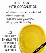 How To Use Coconut Oil For Acne Scars Images