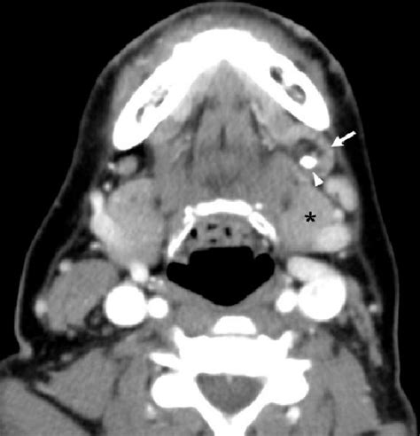 Figure 1 From Sialolithiasis In An Accessory Submandibular Gland