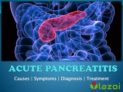 Ppt Acute Pancreatitis Causes Symptoms And Treatments Powerpoint