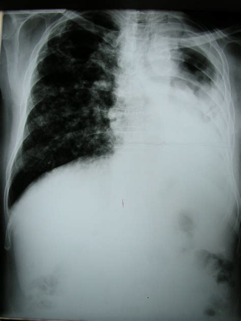 Severe Pulmonary Tuberculosis This Is A Chest X Ray Of A 5 Flickr