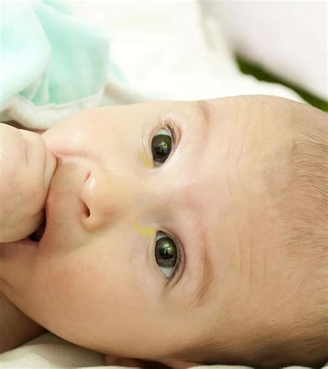 7 Causes Of Sticky Eyes In Newborn Babies And Treatment The Parent
