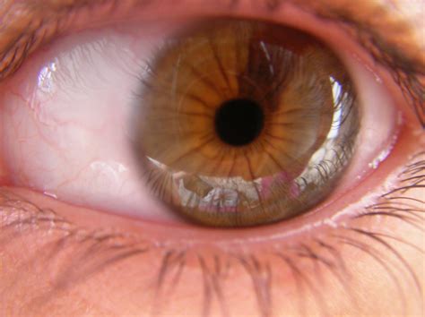 Fileeye With Partial Heterochromia