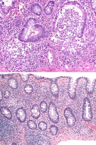 A Crypt Rupture Associated Granulomas In Ulcerative Colitis The Biopsy