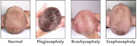 Baby Head Shape Assessment For Plagiocephaly Flat Head Diagnosis