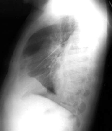 Obliteration of left costophrenic angle with a wide pleural based dome shaped opacity projecting into the lung noted tracking along the cp angle and lateral chest wall suggestive of loculated pleural effusion, however. Dark lung fields