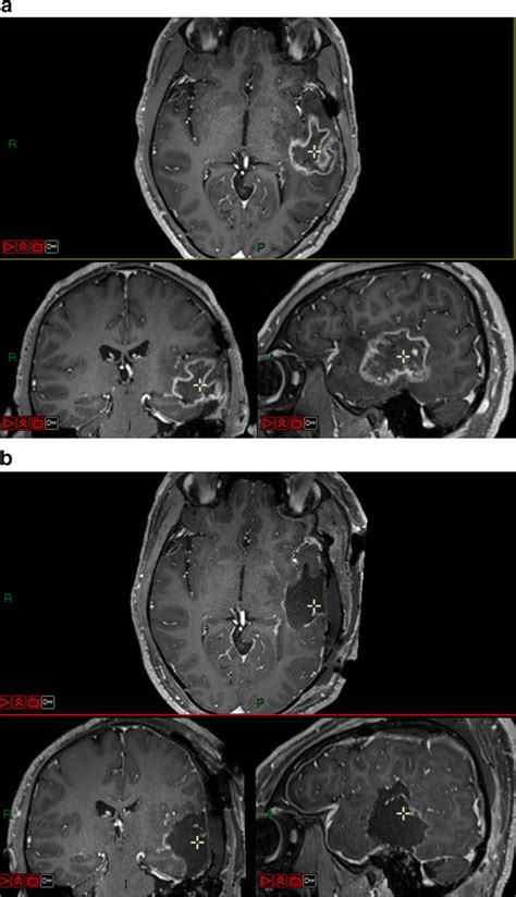 How to install mrt tool. MRI of the illustrative case (T1 with gadolinium sequence ...