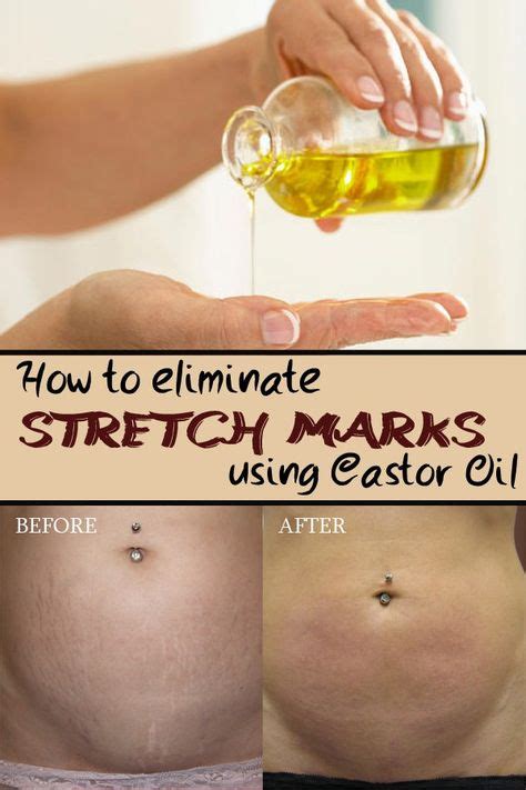 How To Eliminate Stretch Marks Using Castor Oil With Images Oil For