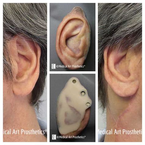auricular patient stories medical art prosthetics