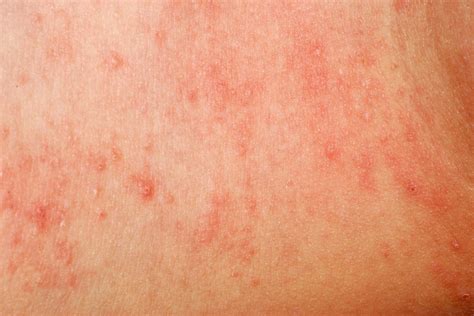 Pictures Of Dermatitis Rash