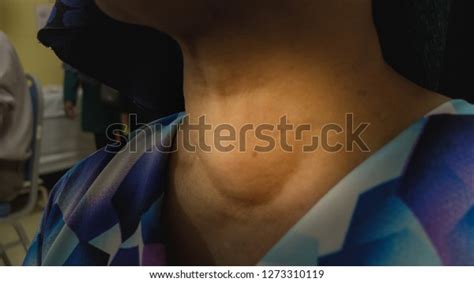 Anterior Next Swelling Thyroid Goitre Stock Photo 1273310119 Shutterstock