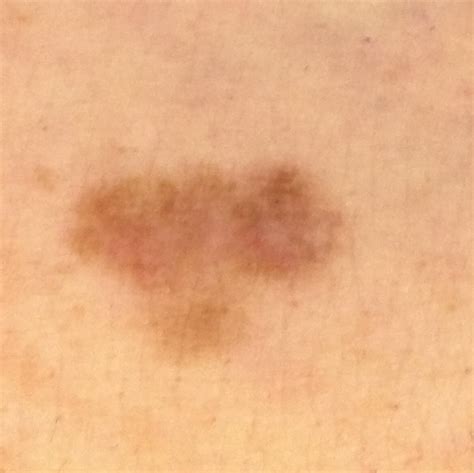 Skin Cancer Symptoms On Arm Idaman