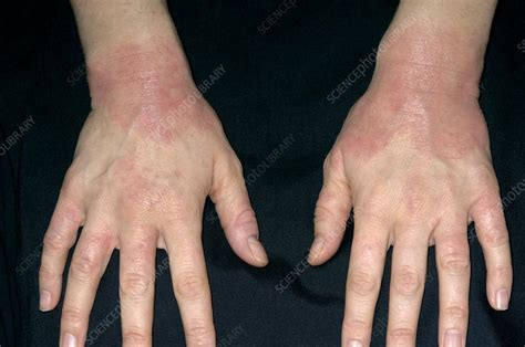 Eczema Affecting The Wrists Stock Image M1500365 Science Photo