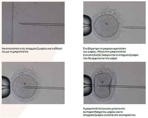 Intracytoplasmic Sperm Injection Icsi