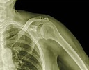 Acromioclavicular (AC) Joint Arthritis: What to Know