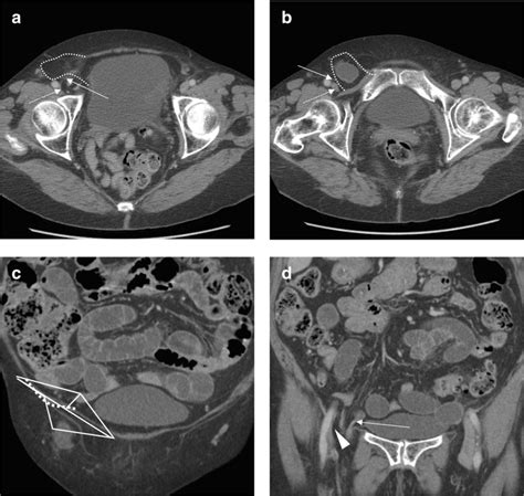 Femoral Hernia Containing Incarcerated Small Bowel Resulting In Small Download Scientific