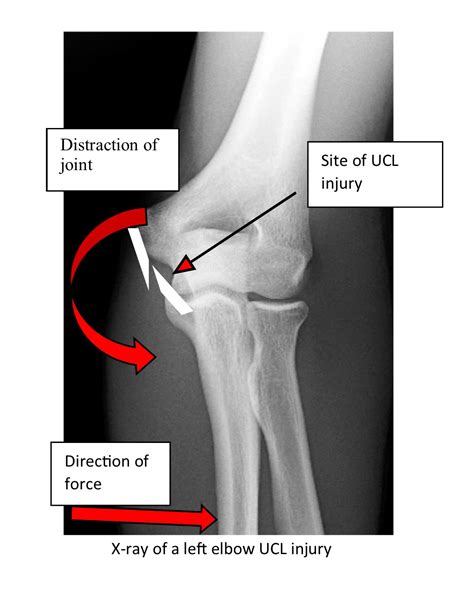 Ulnar Collateral Ligament Elbow Mri