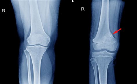 Distal Femur Knee Cartilage Injury Treatment Chillicothe Oh Dr Cohen