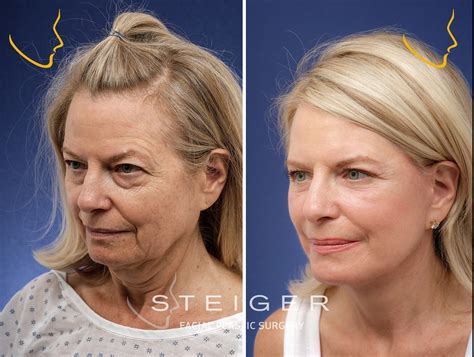 Facelift Before And After Photos Deep Plane Facelift
