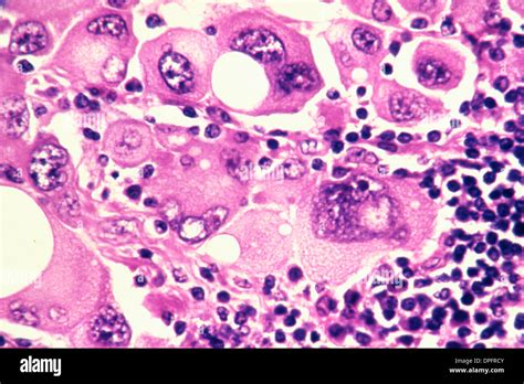 Human Metastatic Melanoma Cells Stock Photo Alamy