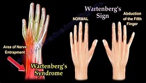 Wartenberg’s Syndrome – Nabil Ebraheim – Medium
