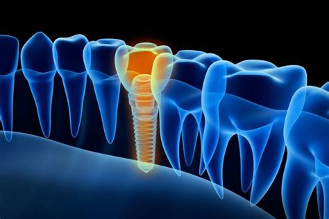 How Dental Implants Transform Your Smile Fine Dentistry Of Downtown