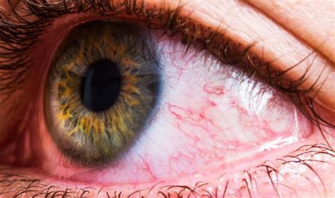 Glaucoma Symptoms Watch Out For Redness In The White Of Your Eye