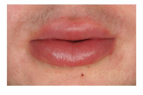 Mouth Ulcers And Lip Swelling British And Irish Society For Oral Medicine