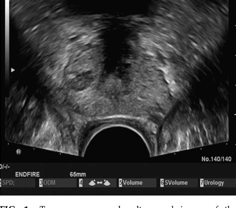 Figure 1 From Status Of Transrectal Ultrasound Imaging Of The Prostate