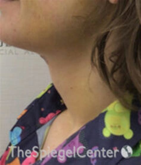 trachea shave boston adam s apple reduction ma neck feminization
