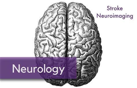 Emergency Guide To Stroke Neuroimaging — Nuem Blog