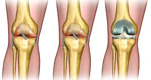 A curved part of cartilage in the knees and other joints that acts as a shock absorber, increases contact area, and deepens the knee joint. | Health Recovery Tips