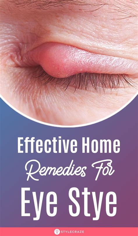 26 Effective Home Remedies For Eye Stye If There Is A Small Red Bump