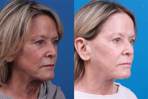 Patient 146900704 Profile Neck Lift Before And After Photos Clevens
